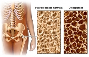 Osteoporoza.jpg