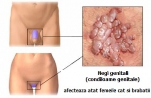 HPV genotipare-uretra - analiza medicala Synevo