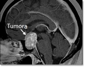 Tumorile glandei pituitare – cancerul hipofizar, Tumora glandei hipofizare și pierderea în greutate