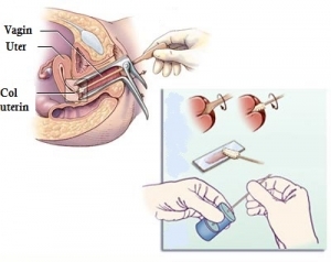 Cancerul de col uterin - diagnostic și tratament