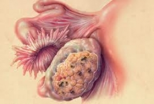 cancerul de ovare cauze