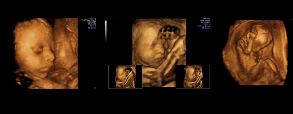 Ecografie Fetala Trimestrul 1 2 3 Pret Morfologie Fetala Donna