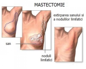 Stadiile cancerului mamar