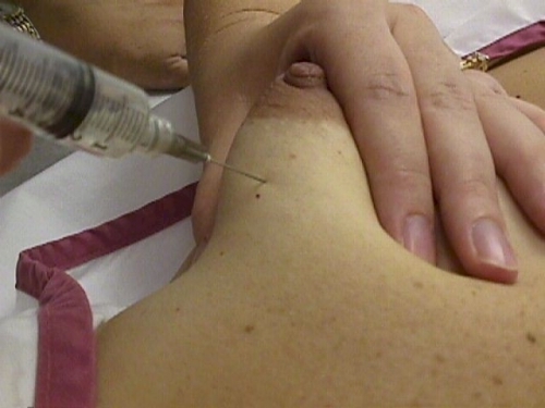 Puncție aspirativă cu ac fin (FNA) pentru chisturile mamare