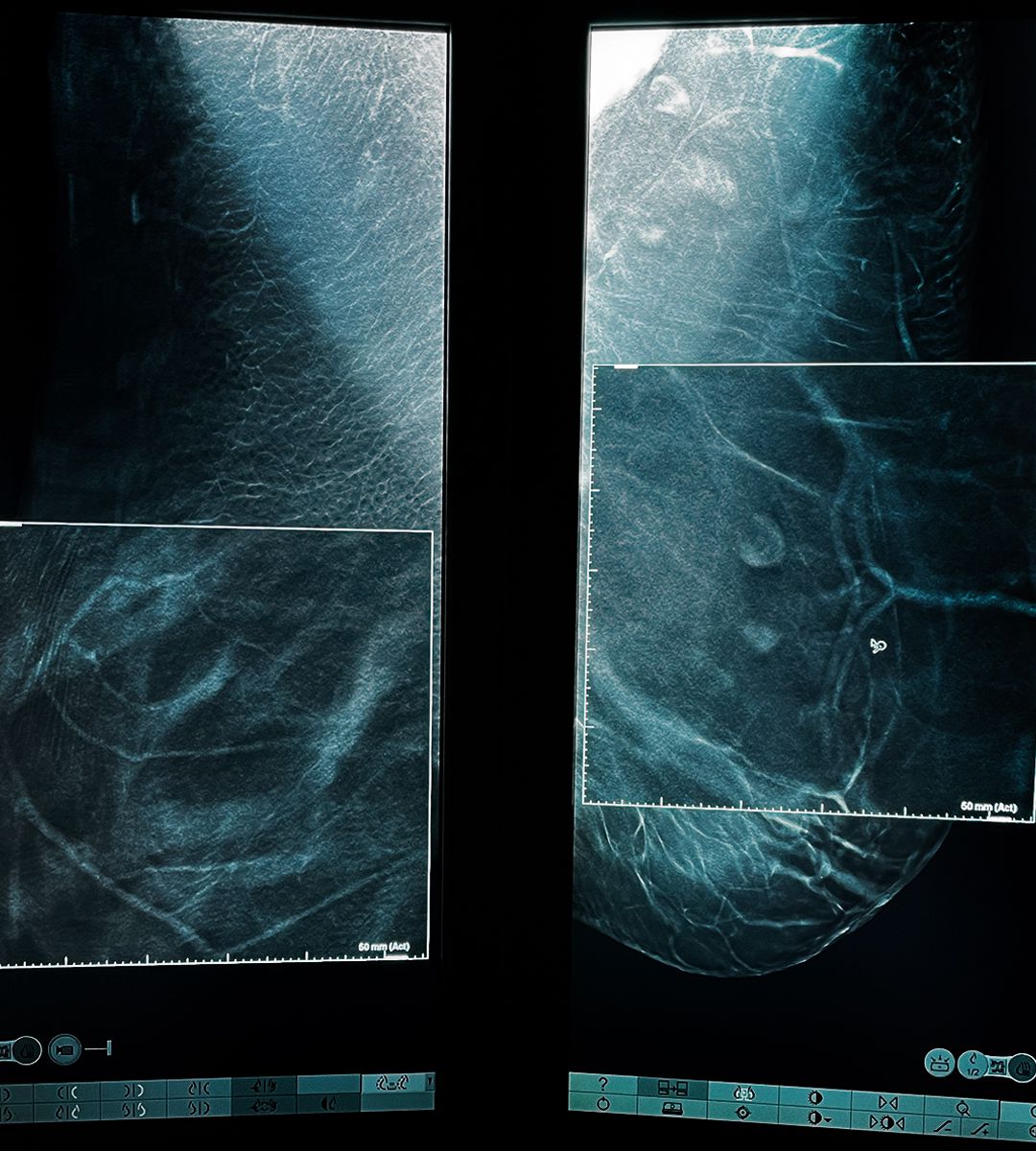 Mamografie digitala 3d cu tomosinteza si soft c view film