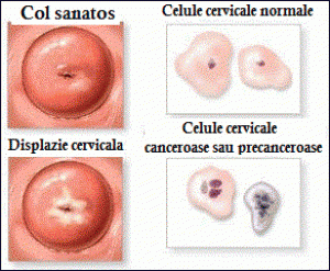 cancerul uterin al virusului papiloma uman
