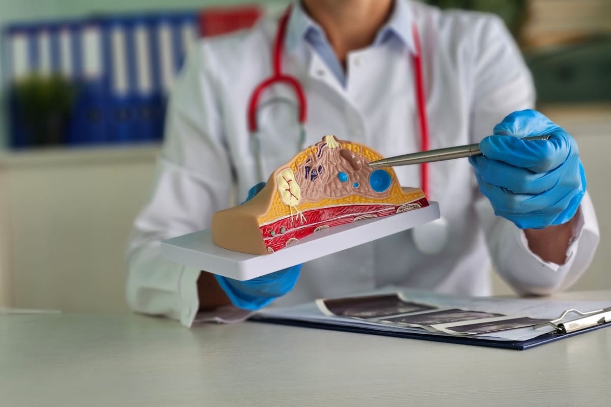 mulaj pentru chist mamar