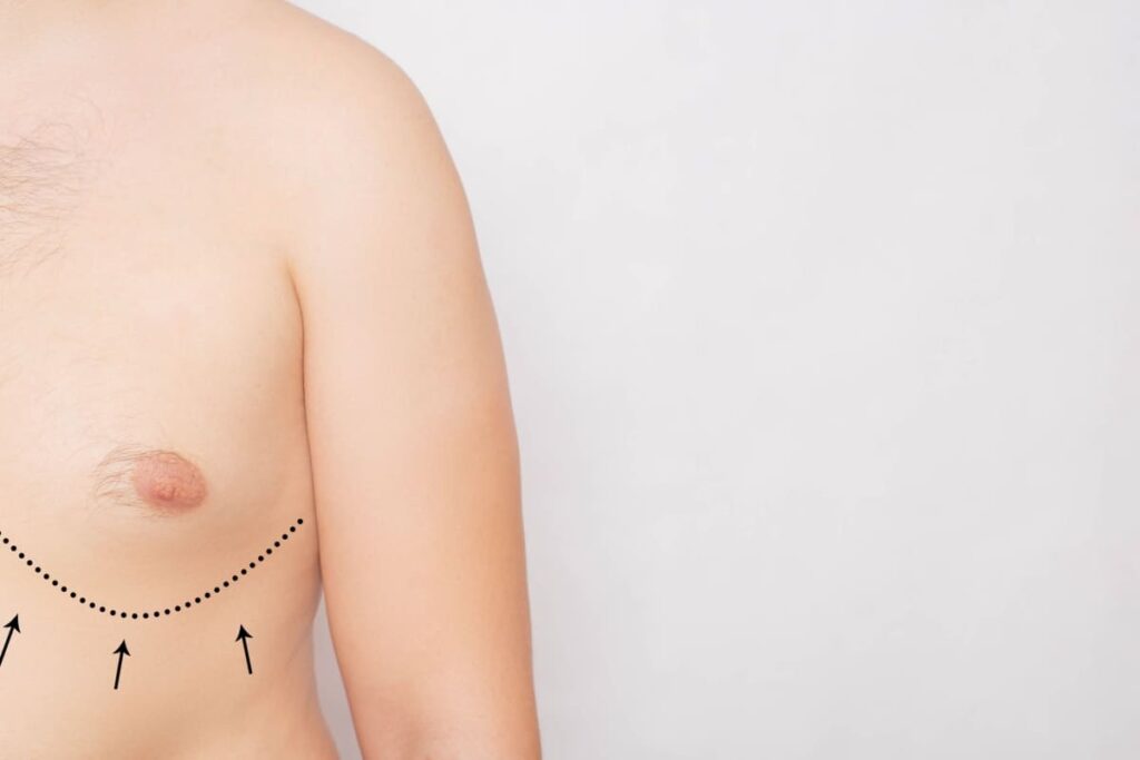 operatia de ginecomastie