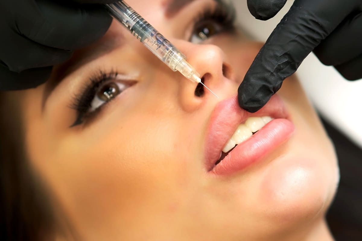 injectare acid hialuronic in buze